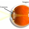 лечения катаракты