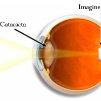 лечения катаракты